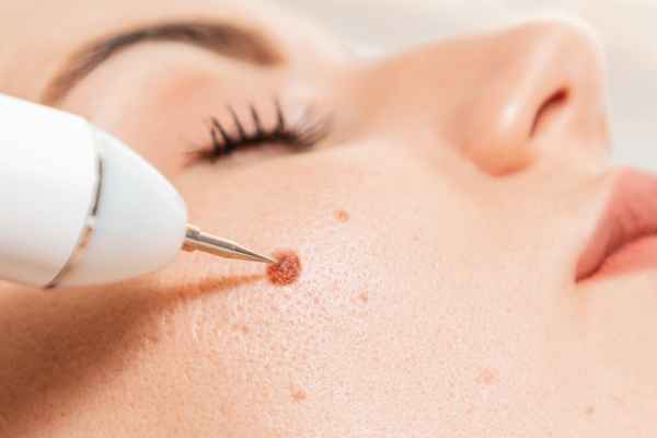 CryoPen: 5 Skin Concerns It May Be Used to Treat 3 What actually happens during a CryoPen treatment Bristol?