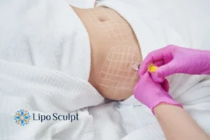 Are The Results From Aqualyx Permanent? 1 Do you want to know how long Aqualyx Bristol results last?