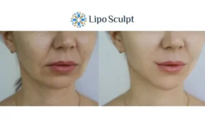 Explaining Total Skin Tightening Treatment And What It Can Do For You 2 Do you want to boost your self confidence? Give Morpheus8 Bristol a try today!