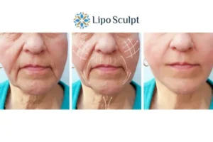 Explaining Total Skin Tightening Treatment And What It Can Do For You 3 Boost your confidence with Morpheus8 Bristol call our team today!