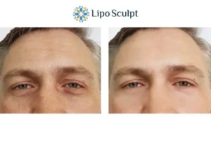 Explaining Total Skin Tightening Treatment And What It Can Do For You 6 Morpheus8 Bristol book in today to find out more!